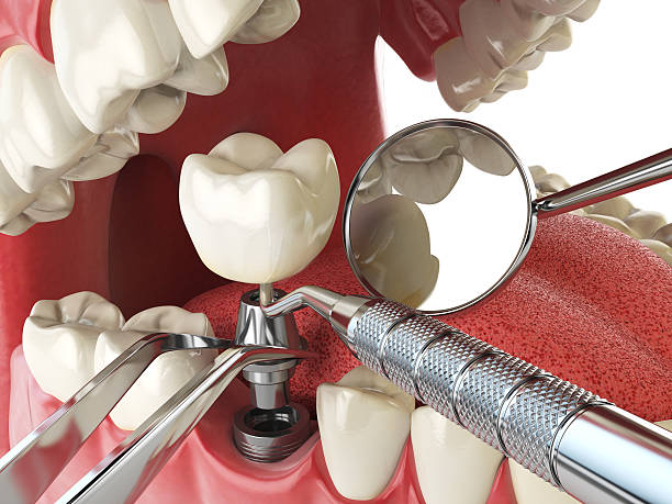 Best Knocked-Out Tooth (Avulsed Tooth) Treatment in Flomaton, AL